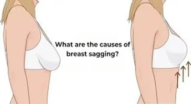 Breast Sagging and Treatments