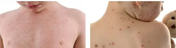 Measles