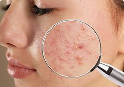 Acne and Pimple